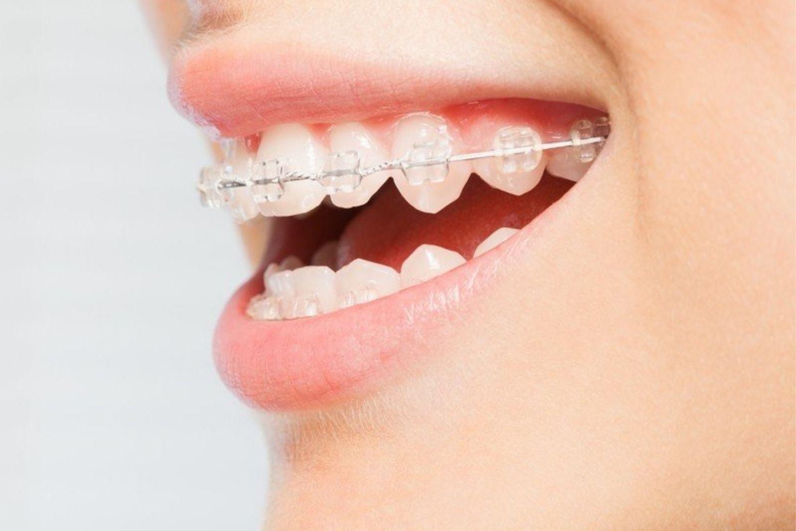 Ortodoncia Estética - Murcia | Clínica Dental Dra. Manzanares