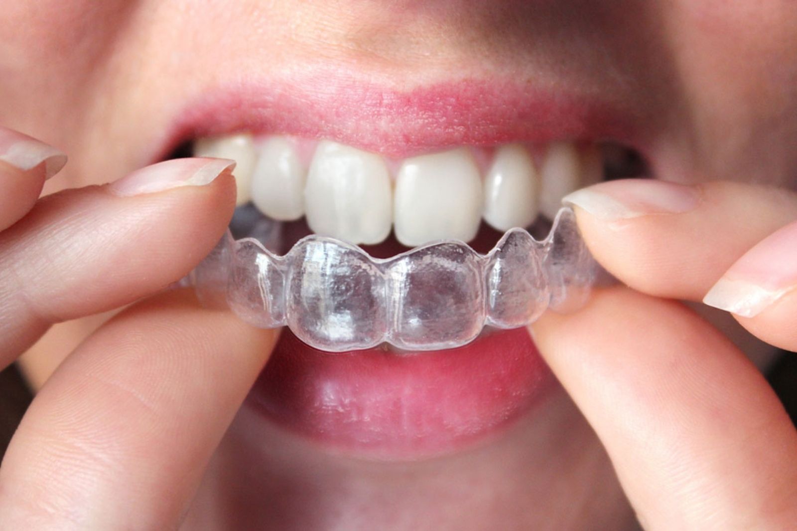 Ortodoncia Invisible - Murcia | Clínica Dental Dra. Manzanares